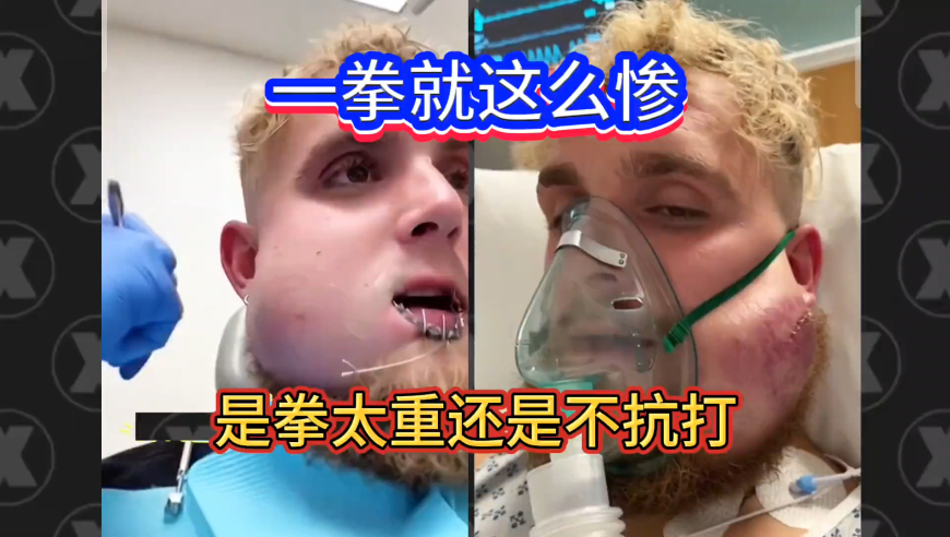 职业拳击被打碎下巴的不止保罗一例｜体坛记忆