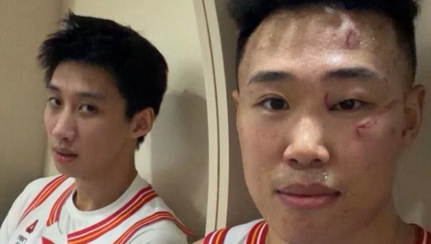 脸上4道伤疤！CBA球员照片触目惊心 这比赛太狠了